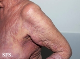 mycosis fungoides