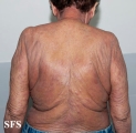mycosis fungoides