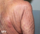 mycosis fungoides