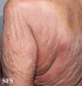 mycosis fungoides