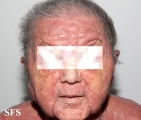 mycosis fungoides
