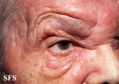 mycosis fungoides
