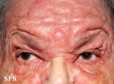 mycosis fungoides