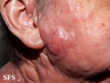 mycosis fungoides