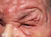 mycosis fungoides