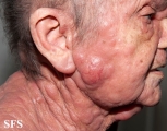 mycosis fungoides