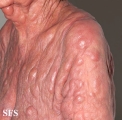 mycosis fungoides