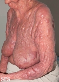 mycosis fungoides