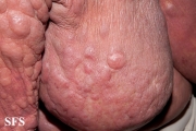 mycosis fungoides