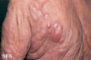 mycosis fungoides