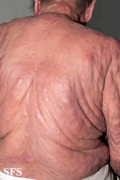 mycosis fungoides