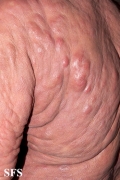 mycosis fungoides