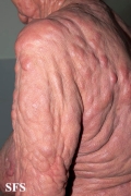 mycosis fungoides