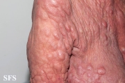 mycosis fungoides