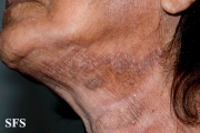 mycosis fungoides