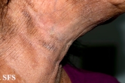 mycosis fungoides
