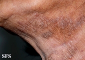 mycosis fungoides