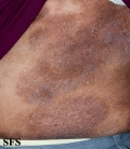 mycosis fungoides