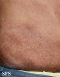 mycosis fungoides