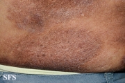 mycosis fungoides
