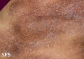mycosis fungoides