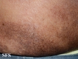 mycosis fungoides