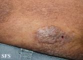mycosis fungoides