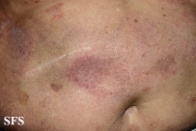 mycosis fungoides