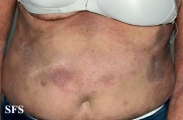mycosis fungoides