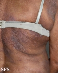 mycosis fungoides