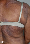 mycosis fungoides