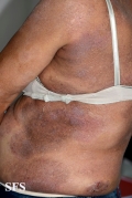 mycosis fungoides