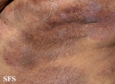 mycosis fungoides