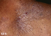 mycosis fungoides