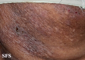 mycosis fungoides
