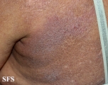 mycosis fungoides