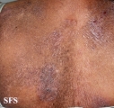 mycosis fungoides