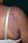 mycosis fungoides