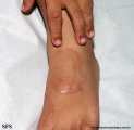 granuloma annulare