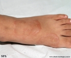 granuloma annulare
