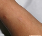 granuloma annulare