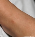 granuloma annulare