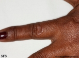 granuloma annulare