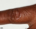 granuloma annulare