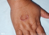 granuloma annulare
