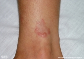 granuloma annulare