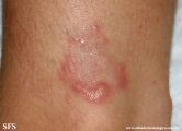 granuloma annulare