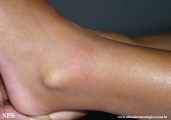 granuloma annulare