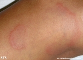 granuloma annulare