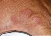 granuloma annulare
